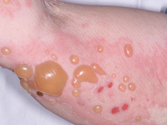 bullous-disorders-Kalasiguda-Secunderabad