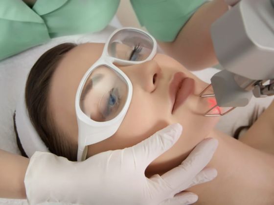 fractional-laser-treatment-SD Road-Secunderabad