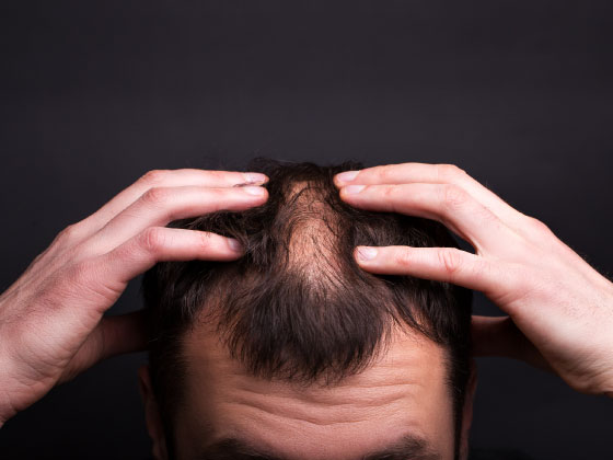 hair-loss-treatment-SD Road-Secunderabad