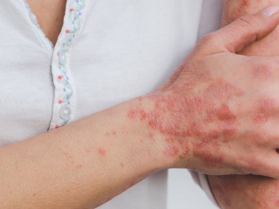 lichen-planus-treatment-SD Road-Secunderabad