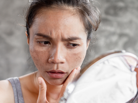 melasma-hyperpigmentation-treatment-SD Road-Secunderabad