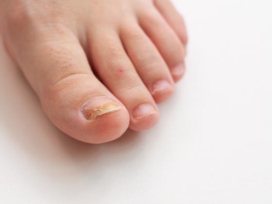 nail-problems-treatment-SD Road-Secunderabad