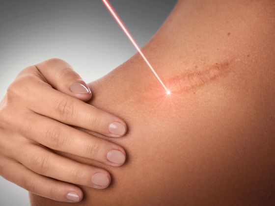 scars-treatment-SD Road-Secunderabad